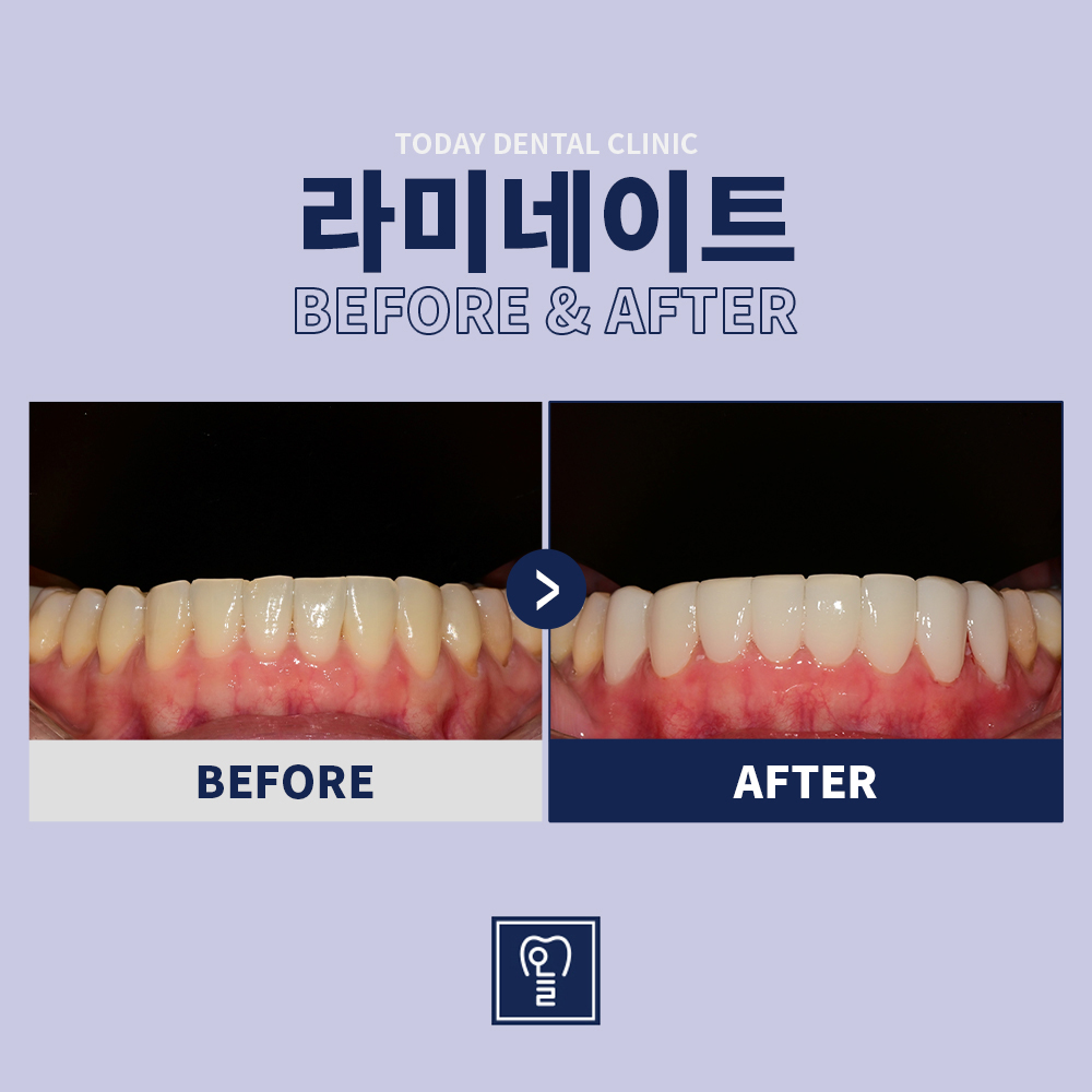 Laminate-veneer · Case 01 · Before / After