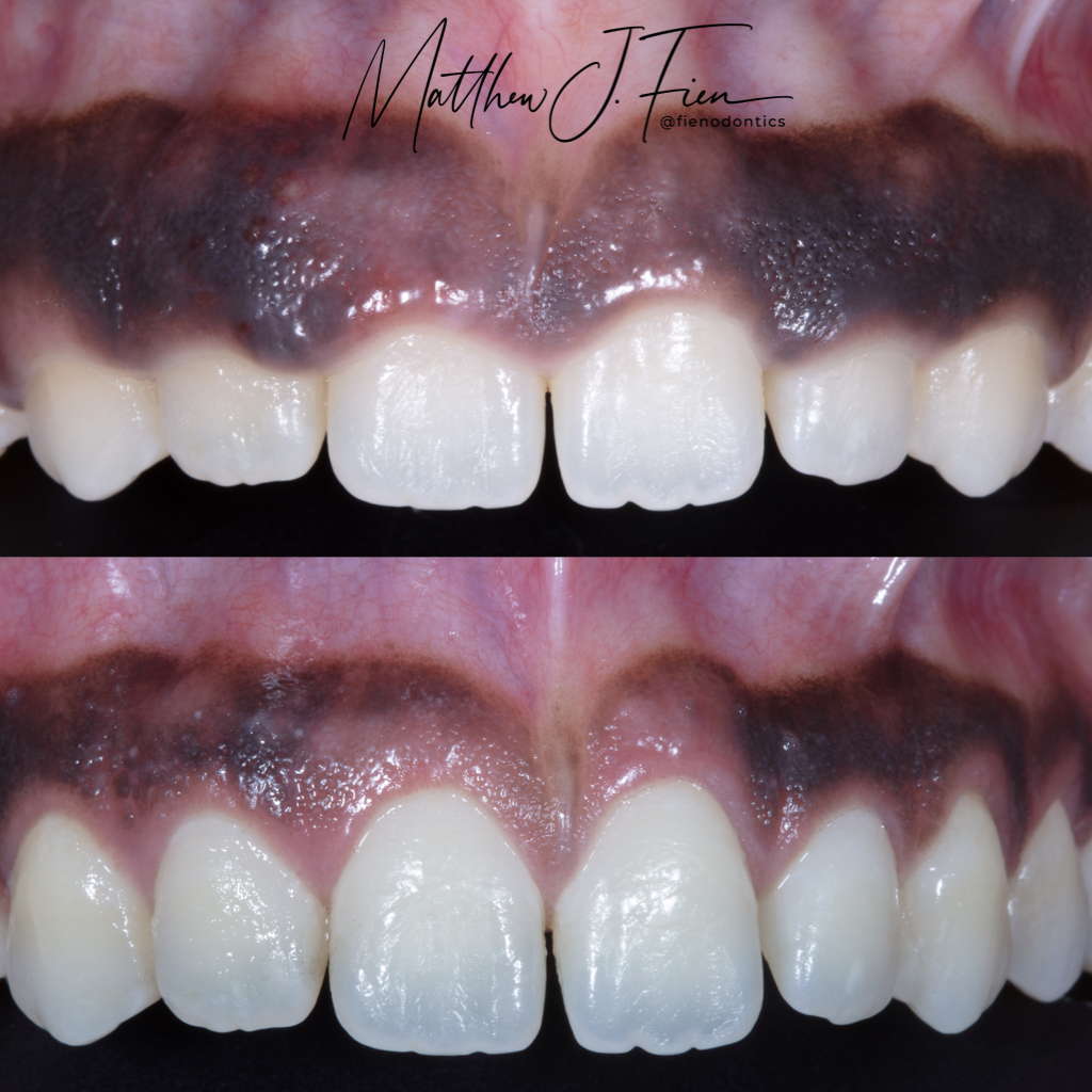 Crown lengthening before and after — full arch gum recontouring by Dr. Fien