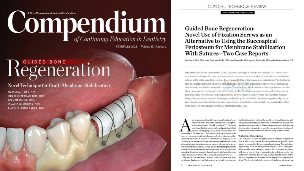 Before and after bone grafting — anterior teeth restored by Dr. Fien