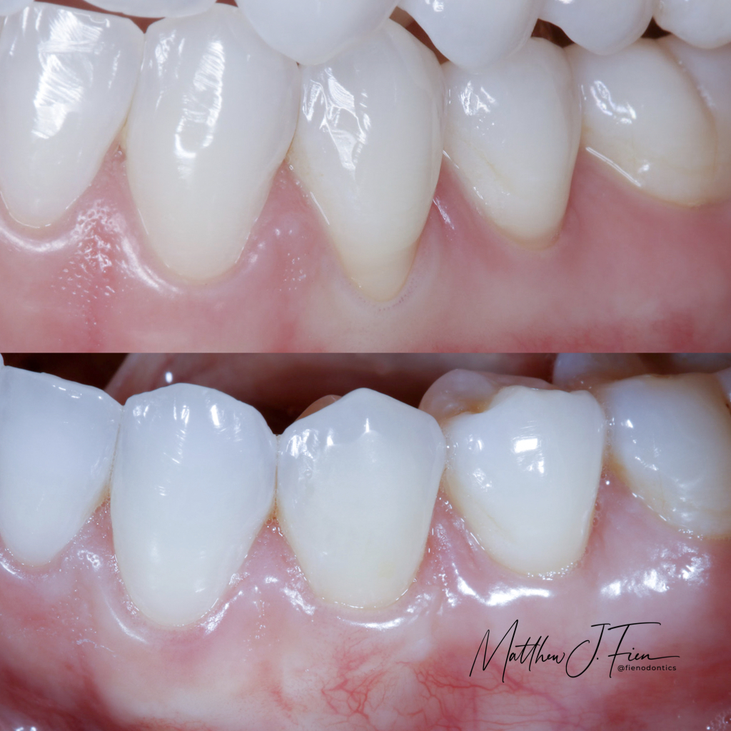 Before and after gum recession treatment — soft tissue grafting by Dr. Fien