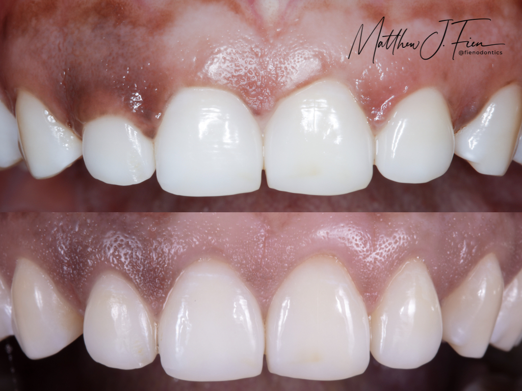 Esthetic crown lengthening before and after — gummy smile correction by Dr. Fien