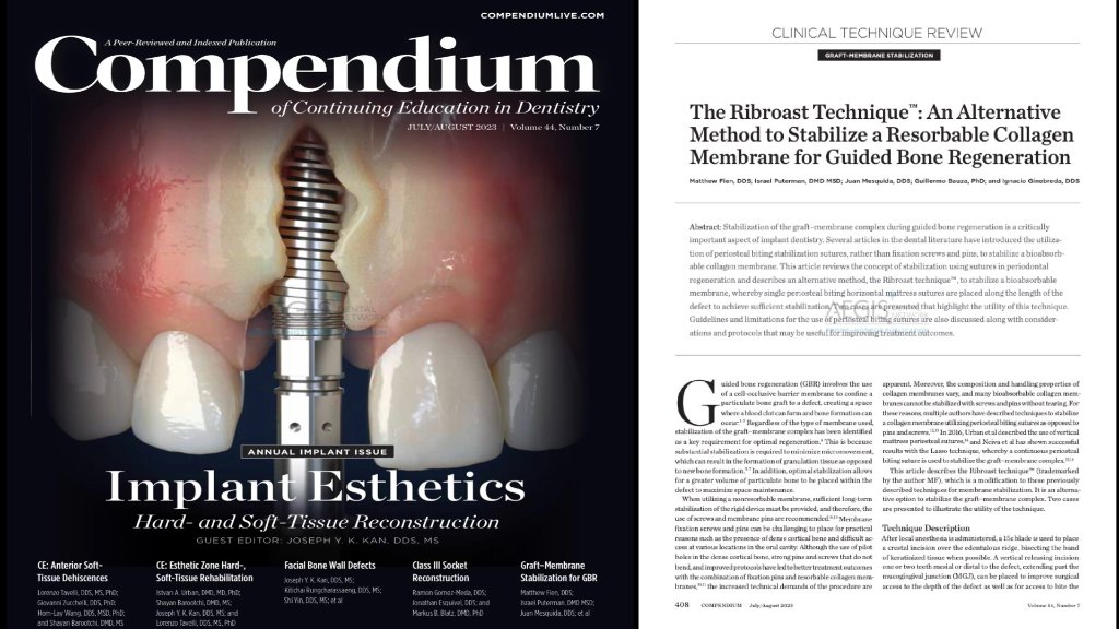 Bone grafting and implant case results by Dr. Mathew J. Fien