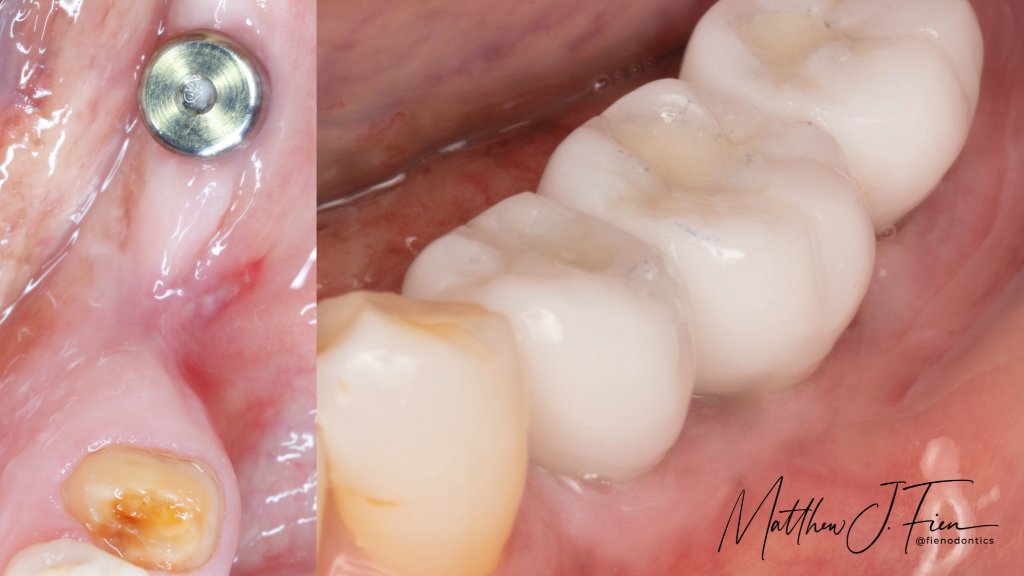 Guided bone regeneration — graft membrane and fixation screws — Dr. Fien case