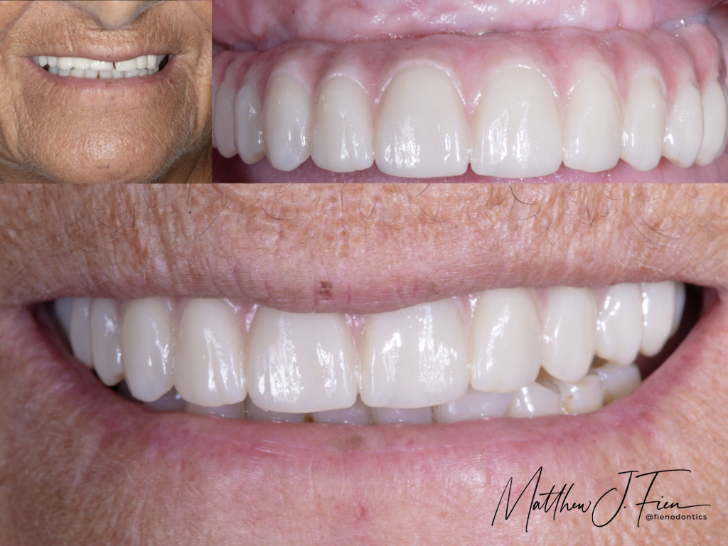 ALL-ON-4 smile transformation by Dr. Mathew J. Fien