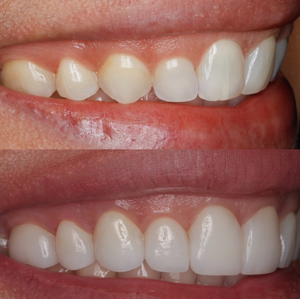 Esthetic crown lengthening before and after — Dr. Mathew J. Fien