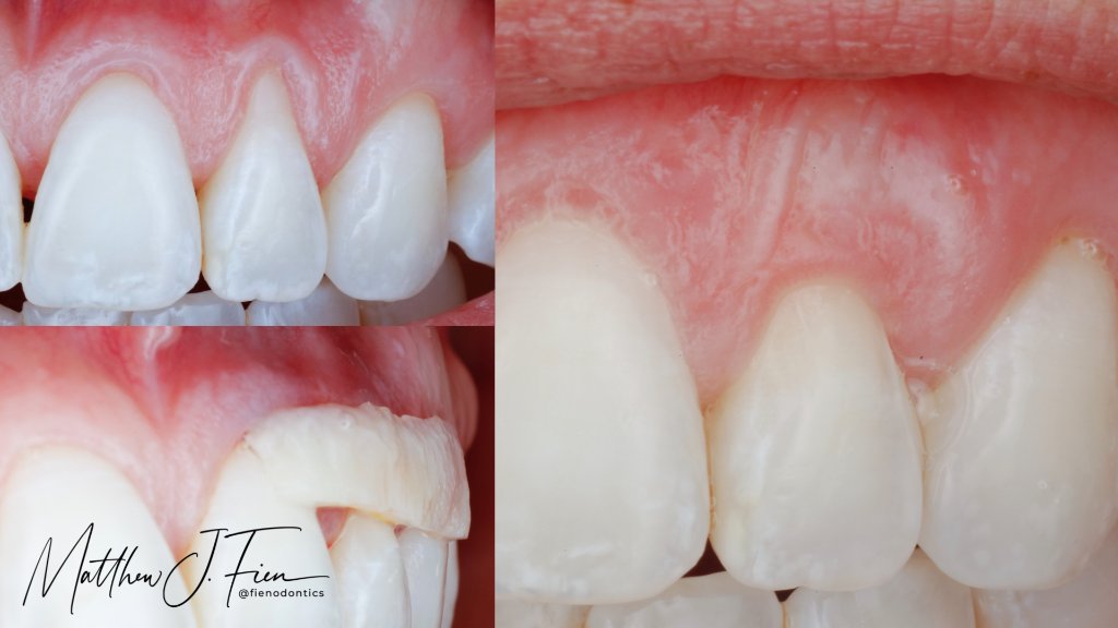 Minimally invasive soft tissue grafting — before and after gum recession treatment by Dr. Fien