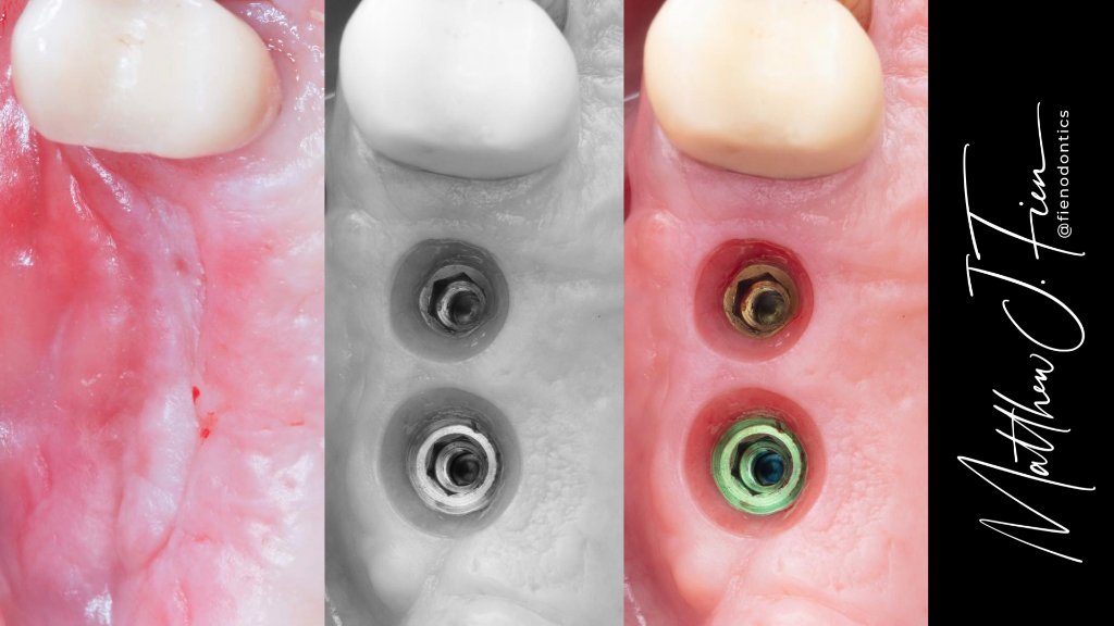 Implant placed then fully restored with molar crowns — Dr. Fien case