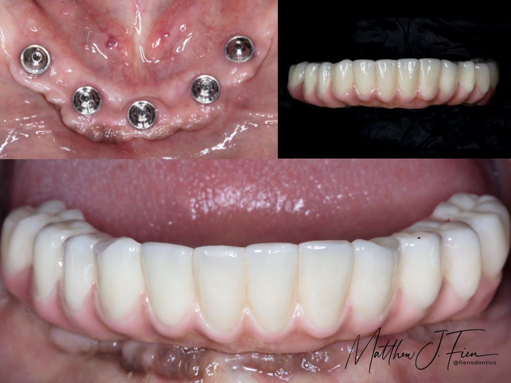 ALL-ON-4 implant abutments placed and final prosthetic fitted — Dr. Fien case