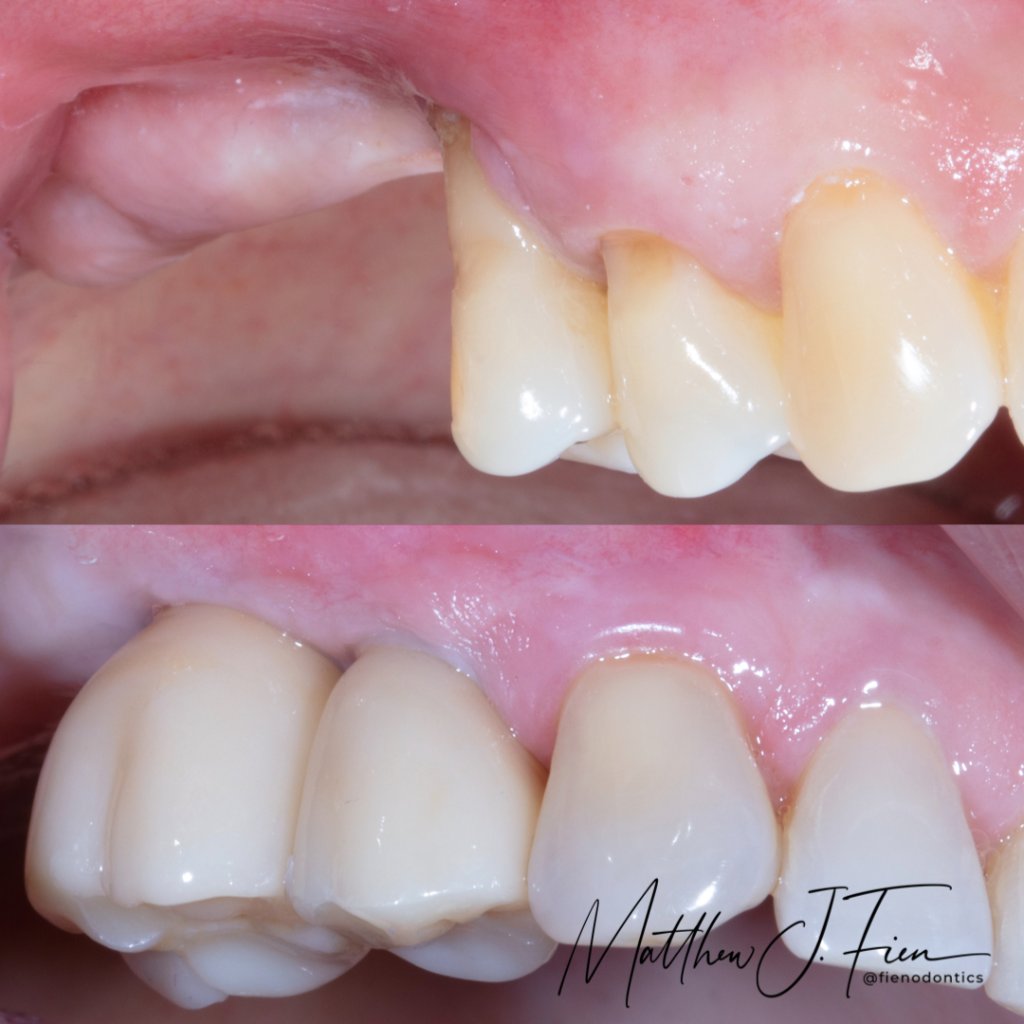 Extraction site preserved and restored with implant crowns — Dr. Fien case