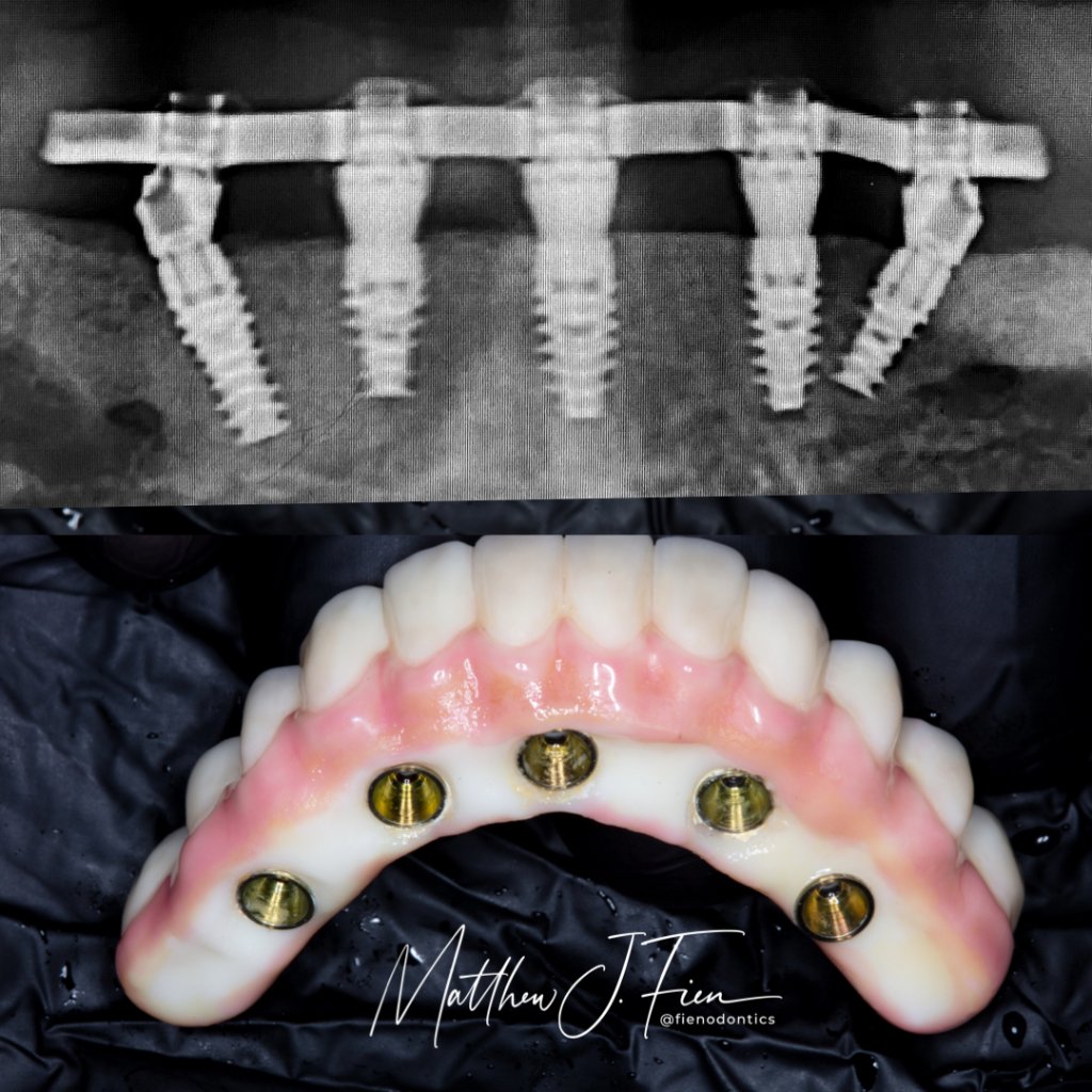 X-ray showing ALL-ON-4 implant placement and precision-crafted bridge by Dr. Fien