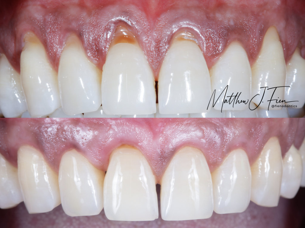 Before and after molar gum recession — soft tissue graft result by Dr. Fien