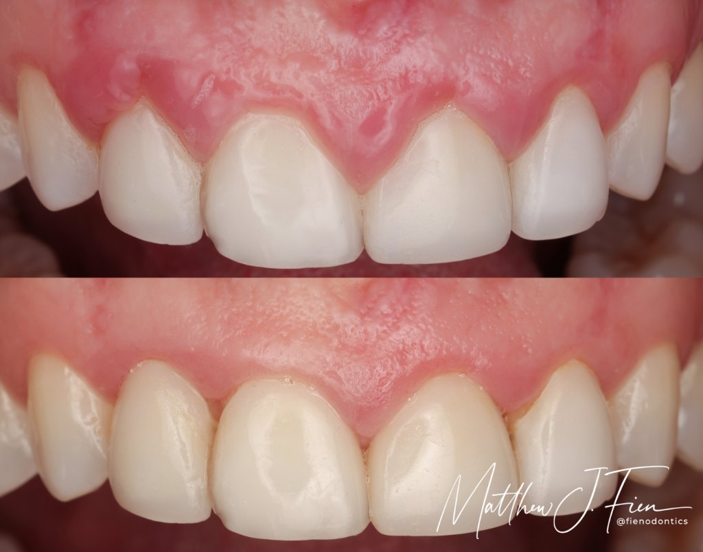 LANAP gum disease treatment before and after — Dr. Mathew J. Fien