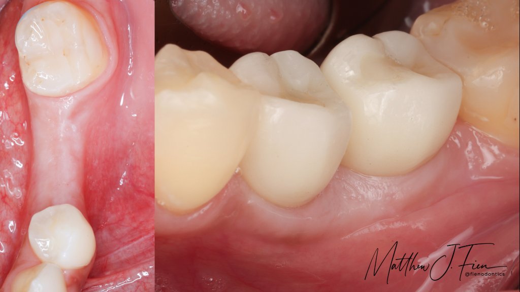 Dr. Fien's Rib Roast Technique published in Compendium of Continuing Education in Dentistry