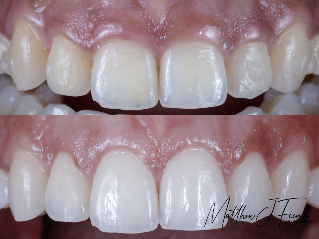 Crown lengthening before and after — close-up central incisors by Dr. Fien