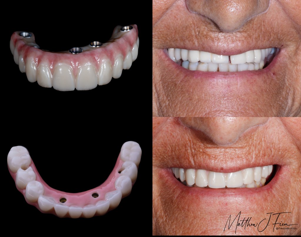 ALL-ON-4 arch prosthetics and patient before-after smile — Dr. Fien case