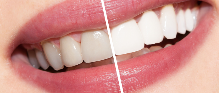 Pediatric & Teen Teeth Whitening: A Parent's Guide to Safe, Confident Smiles