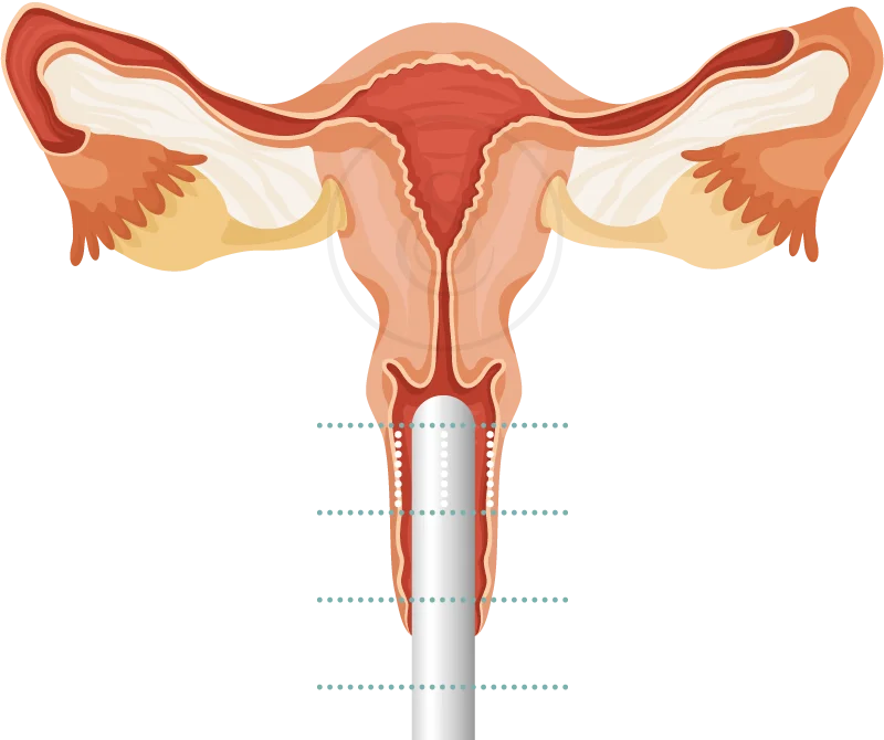 HIFU vaginal rejuvenation probe device illustrating the treatment