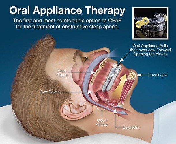 Oral appliance used for sleep apnea treatment
