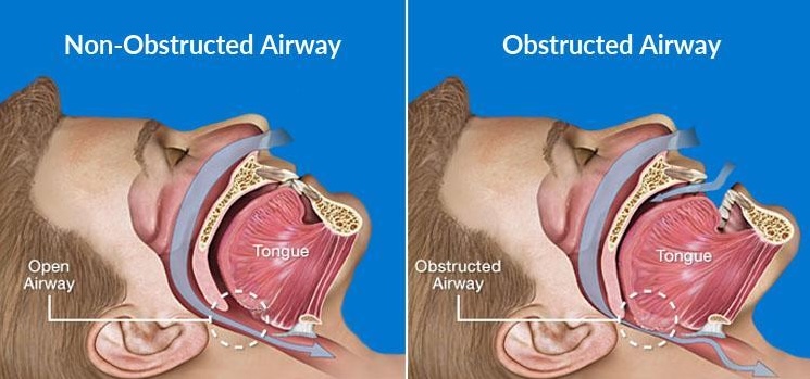 Obstructed vs non-obstructed airway diagram