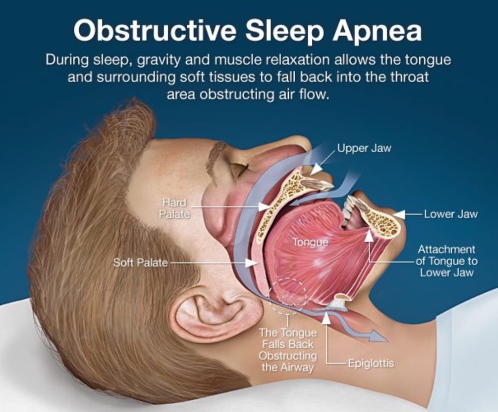 Obstructive Sleep Apnea diagram