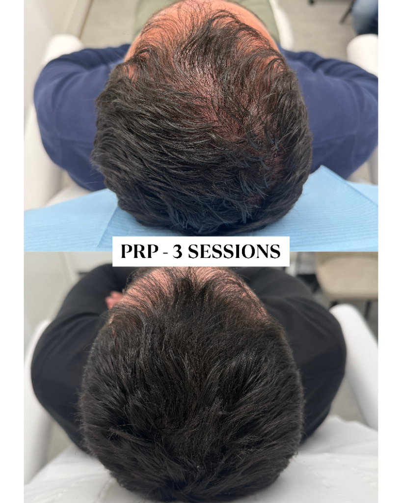 PRP hair loss before and after results London — patient 1 after 3 sessions at One Aesthetics Camberwell