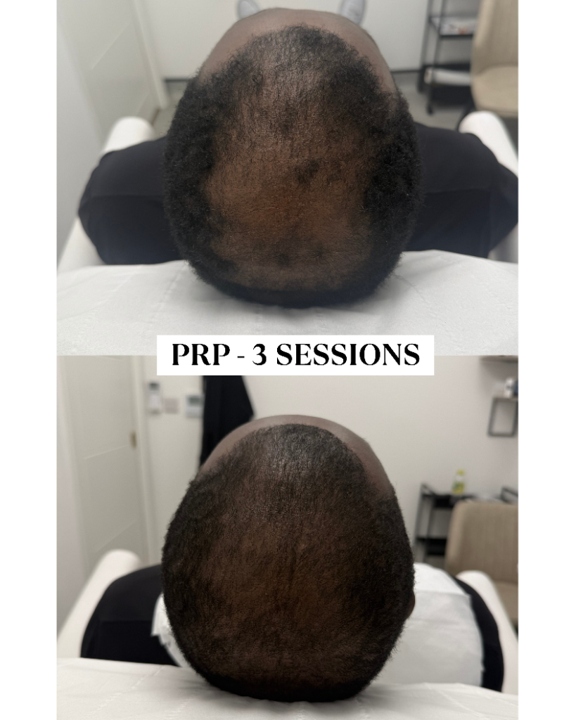 PRP hair loss before and after results London — patient 2 after 3 sessions at One Aesthetics Camberwell
