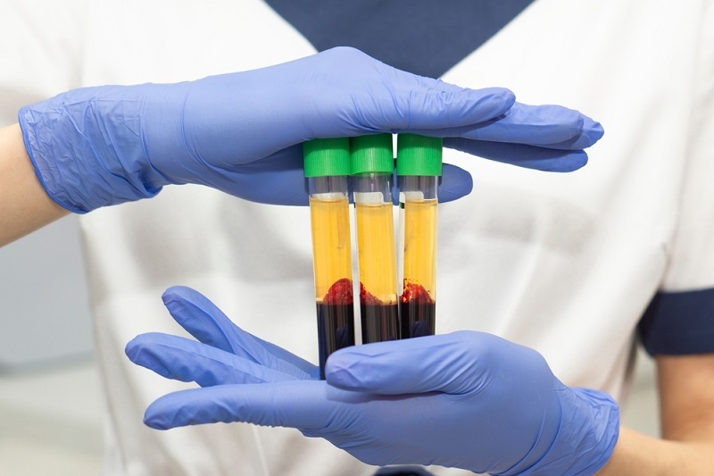 PRP Hair Loss London: Platelet Rich Plasma Treatment
