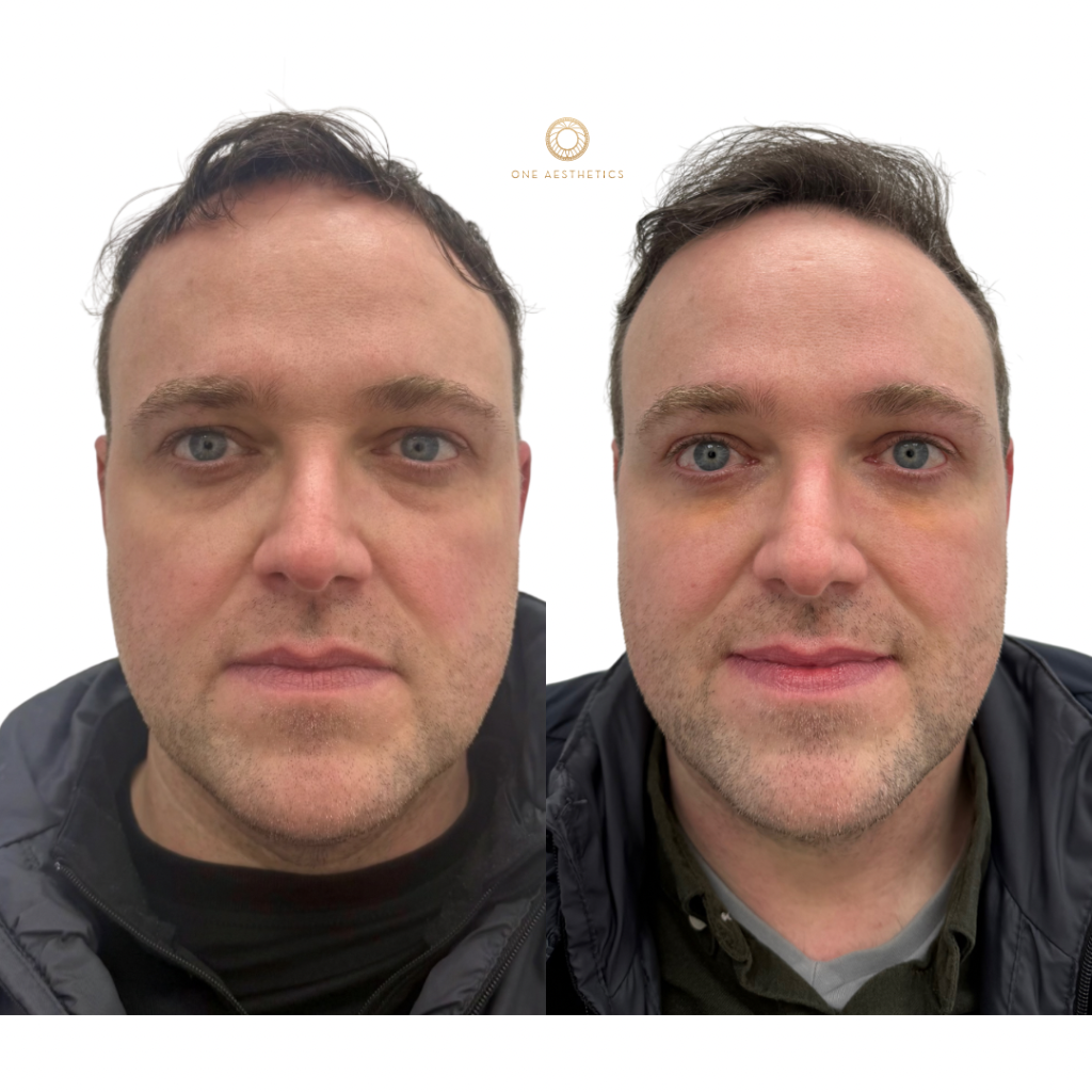 Tired Eyes Treatment London: Sunekos Performa vs Tear Trough Filler