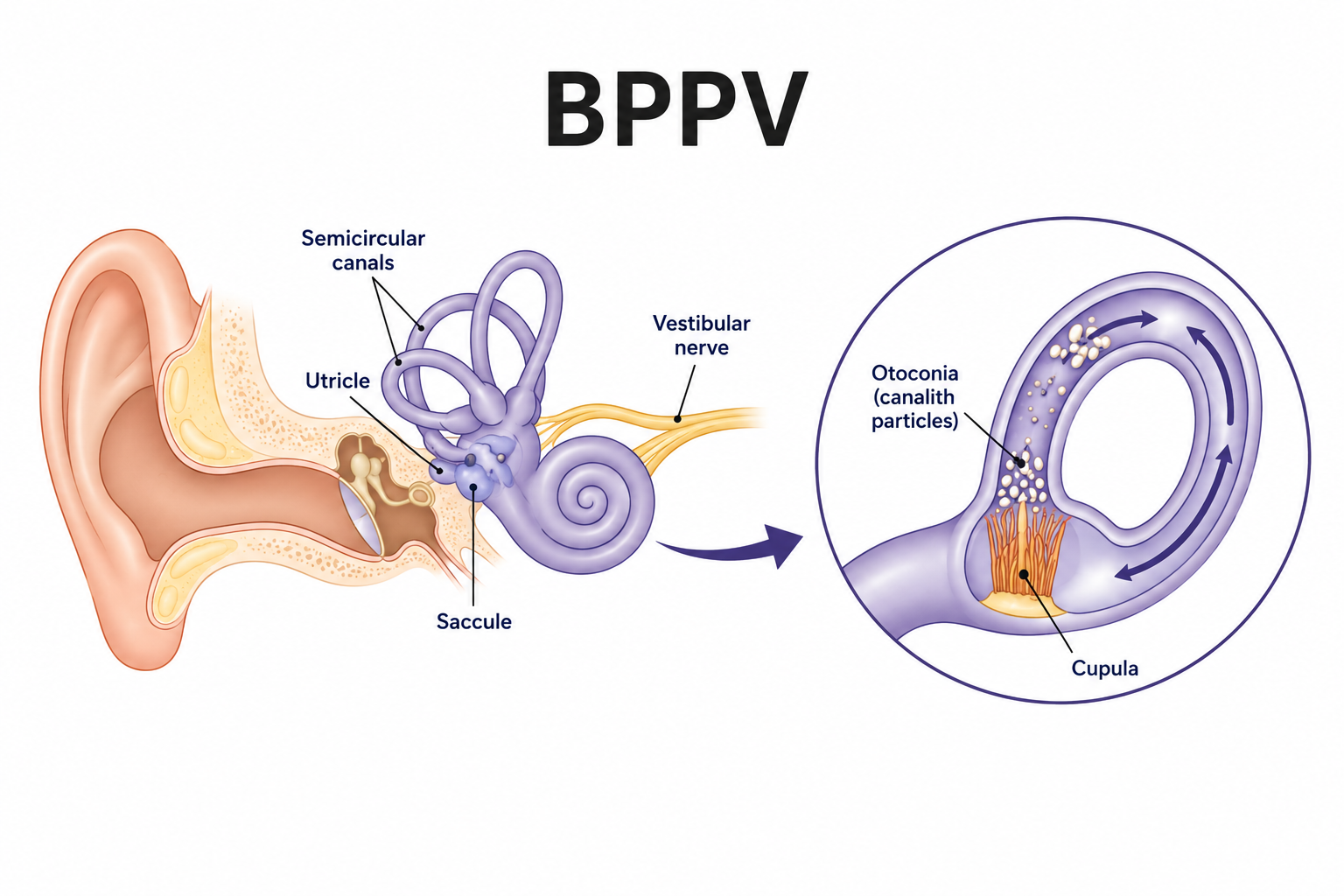 Benign Paroxysmal Positional Vertigo (BPPV)