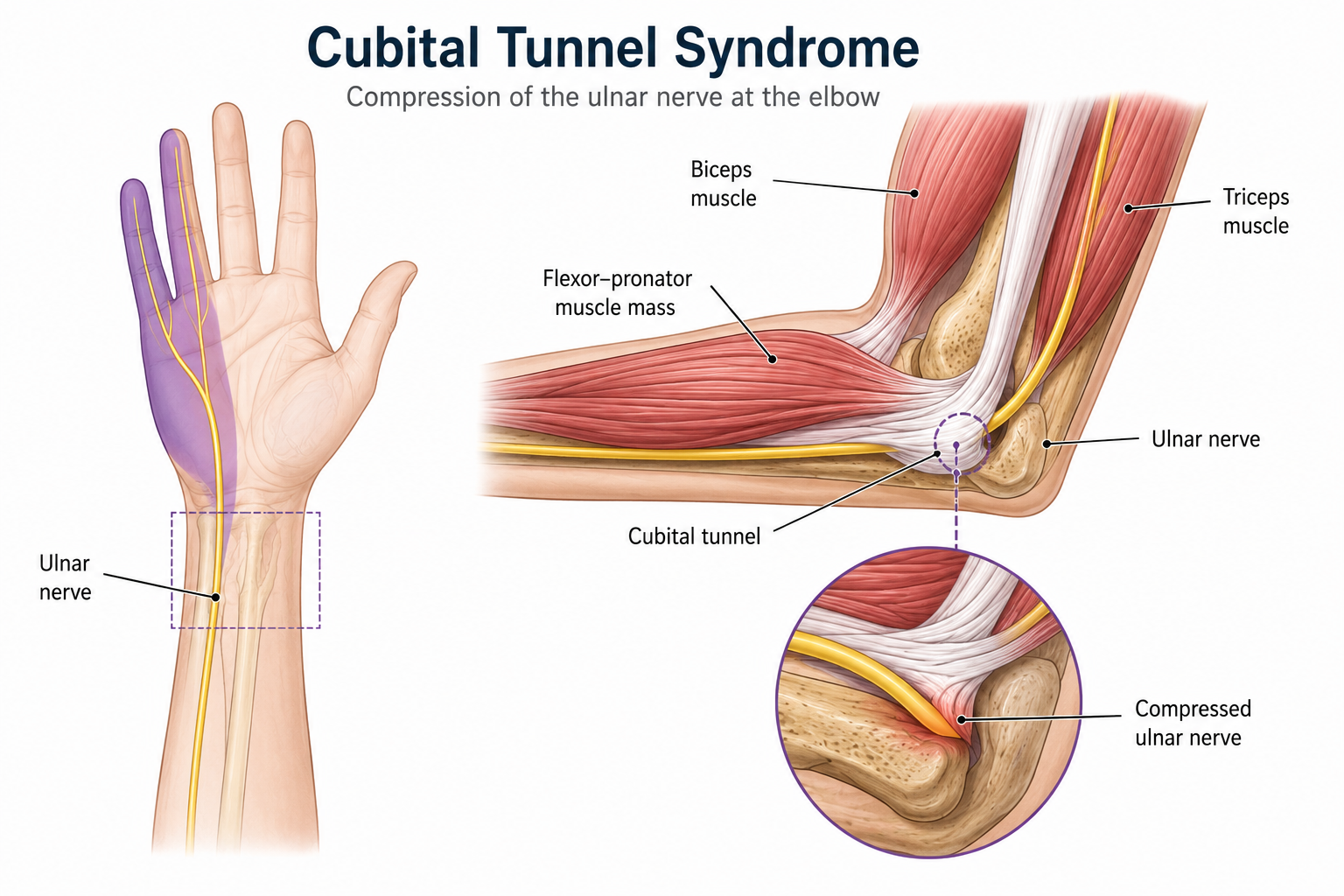 Cubital Tunnel Syndrome