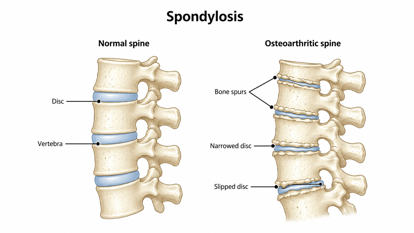 Spinal Spondylosis
