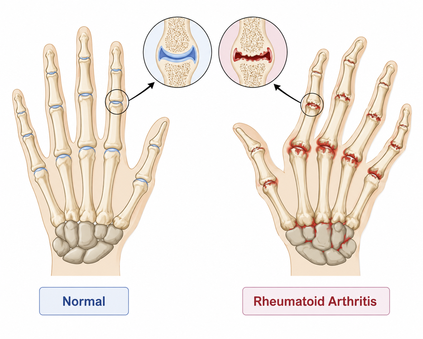 Rheumatoid Arthritis