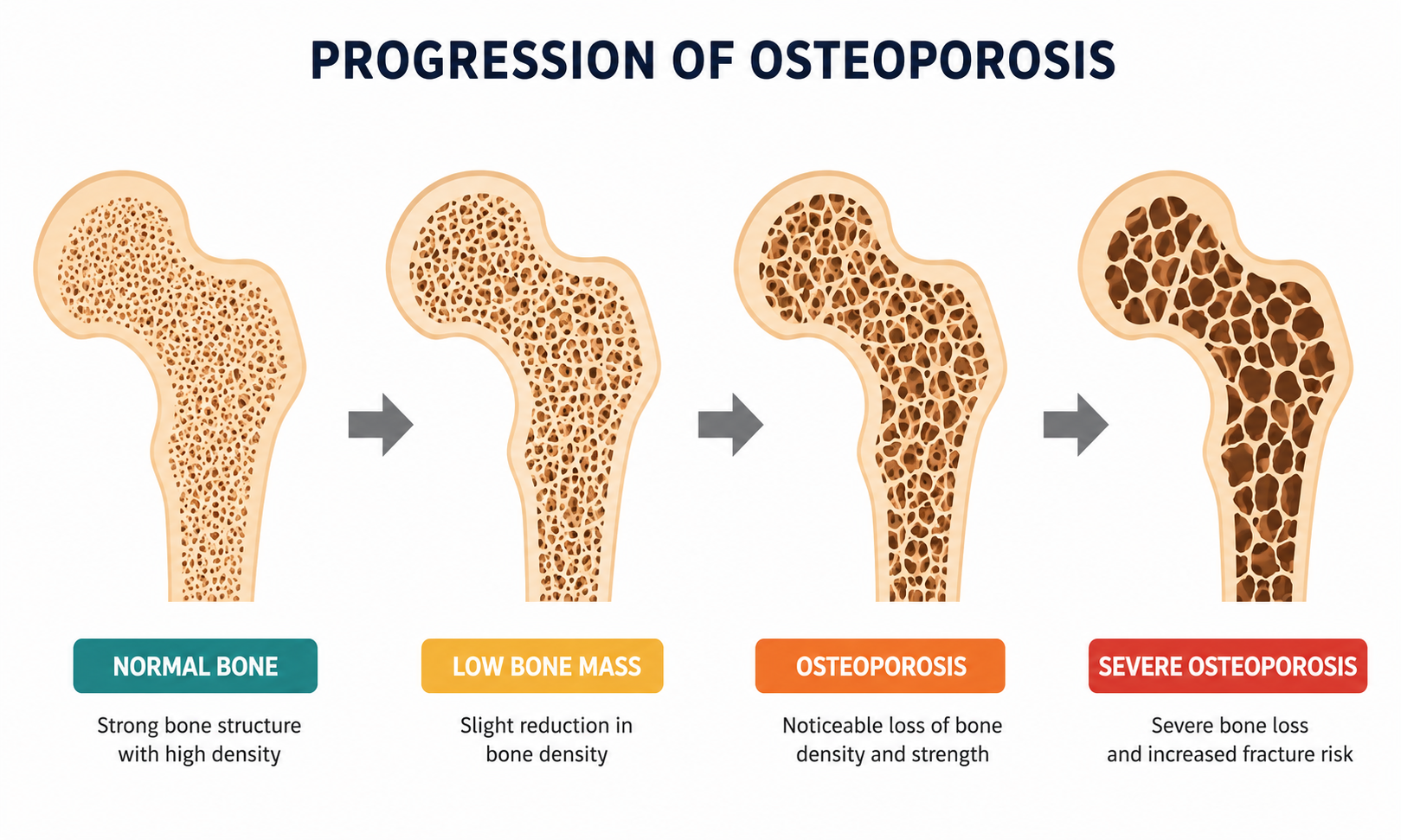 Osteoporosis