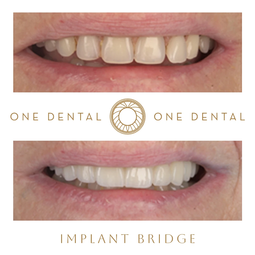 Implant Bridge before and after