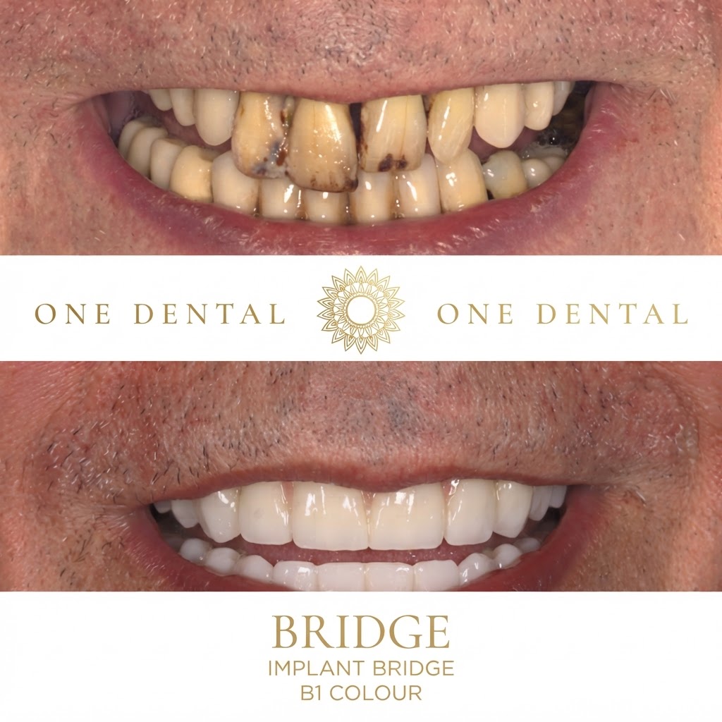 Implant Bridge before and after