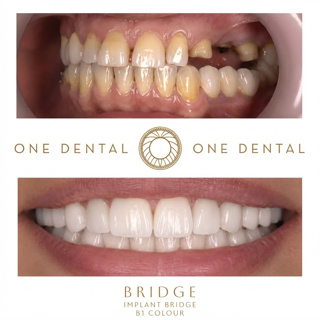Implant Bridge before and after