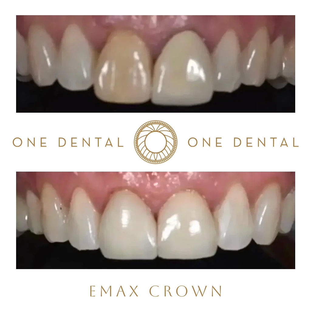 Emax Crown before and after