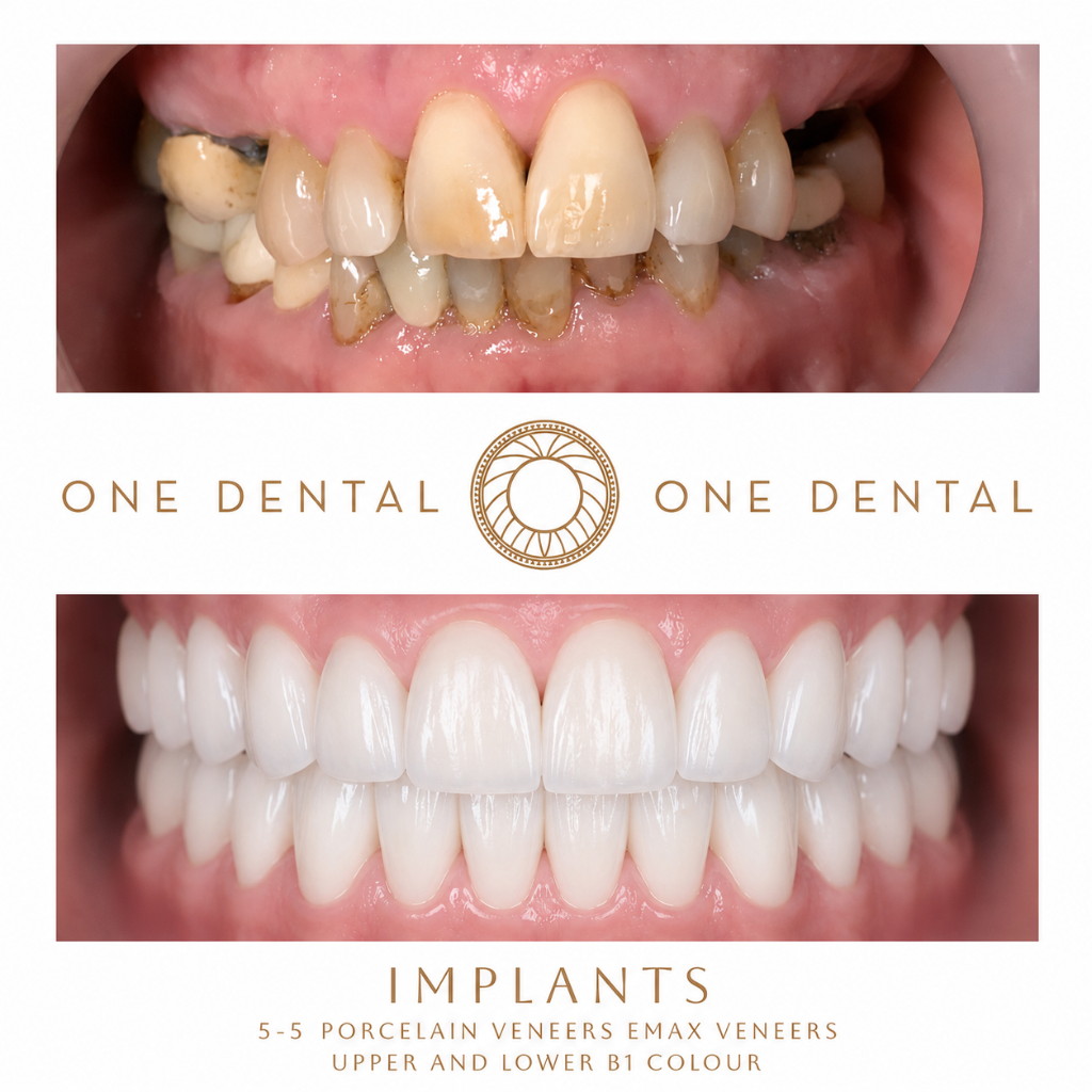 Implants before and after