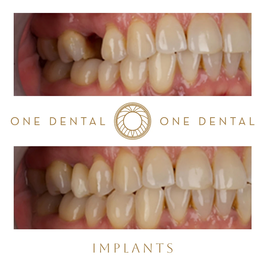 Implants before and after