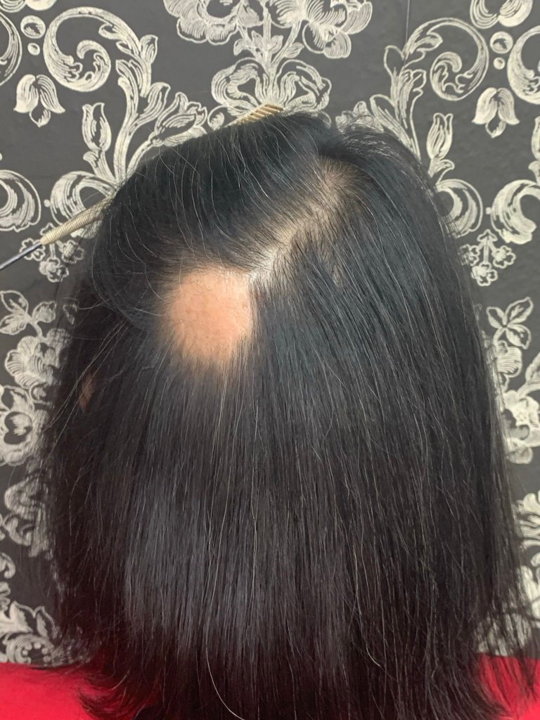 Antes - Alopecia areata