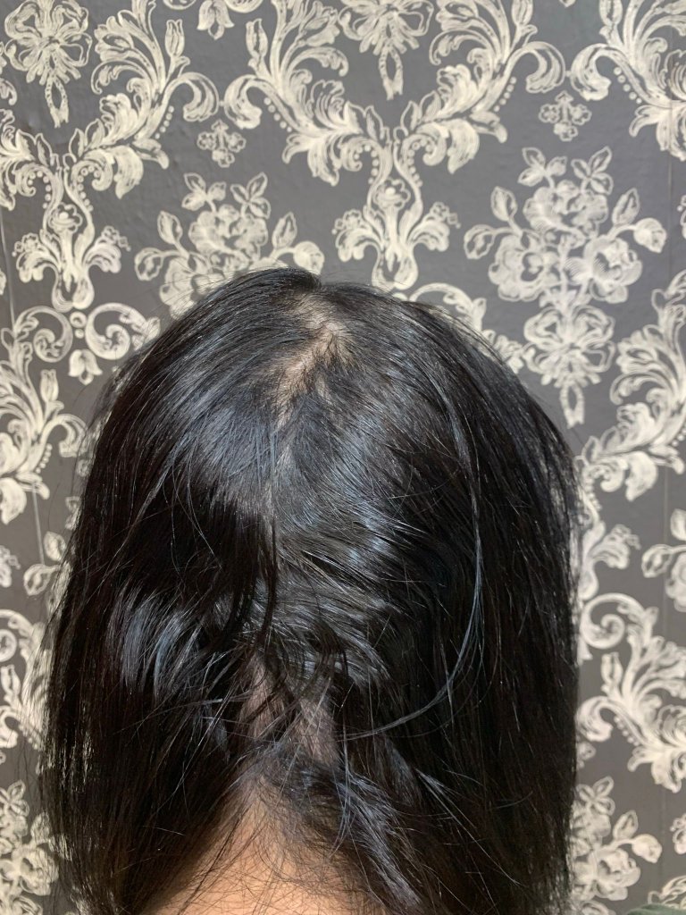 Después - Alopecia areata