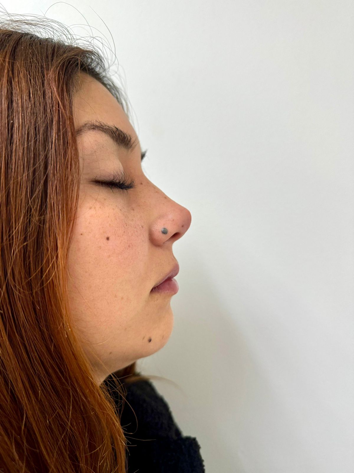 Armonización facial en perfil