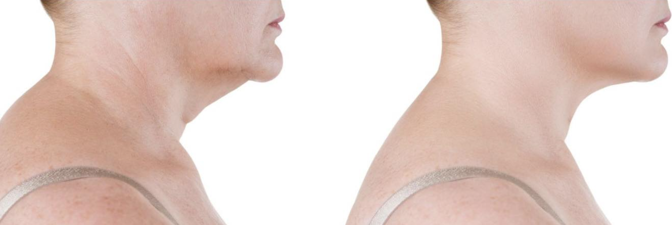 Before and after facial