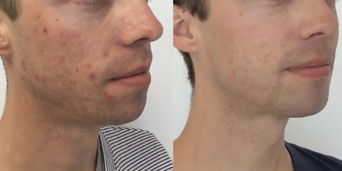 Skincare transformation results