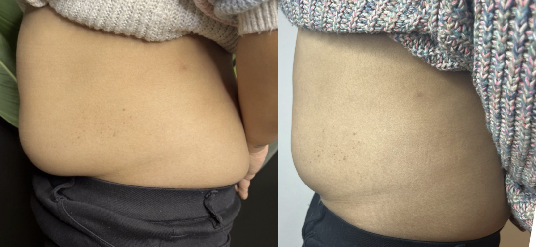 Before and after results