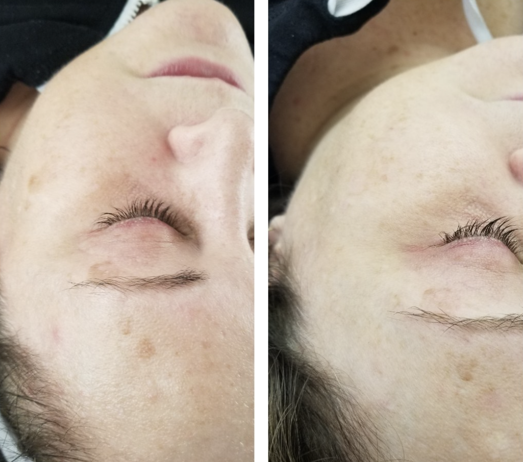 Client skincare transformation