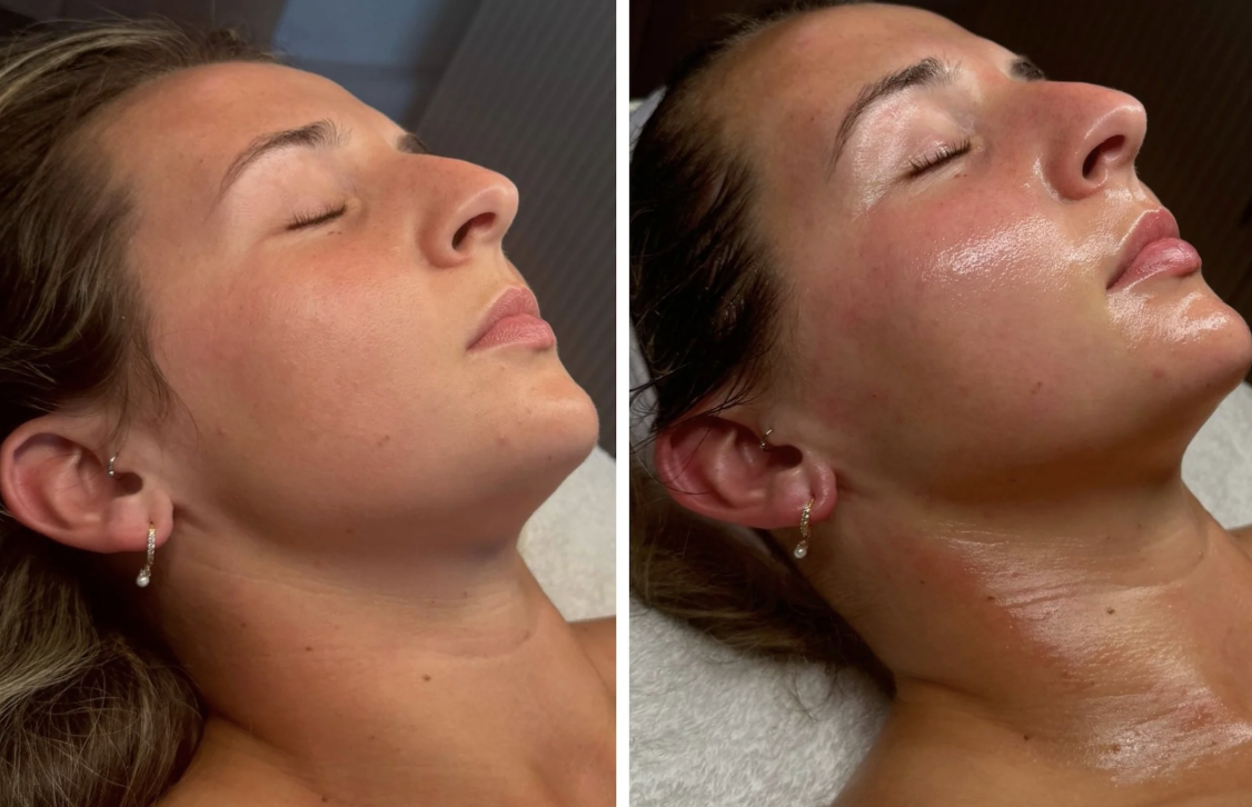 LED and dermaplaning treatments