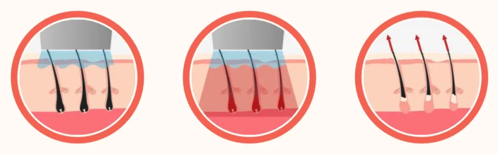 Schéma des 3 étapes de l'action du laser sur le bulbe pileux