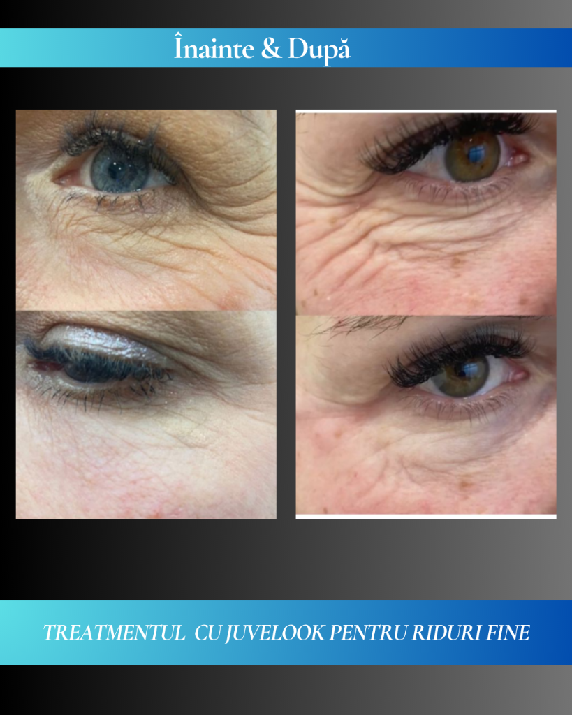 Rezultat clinic JuveLook 1