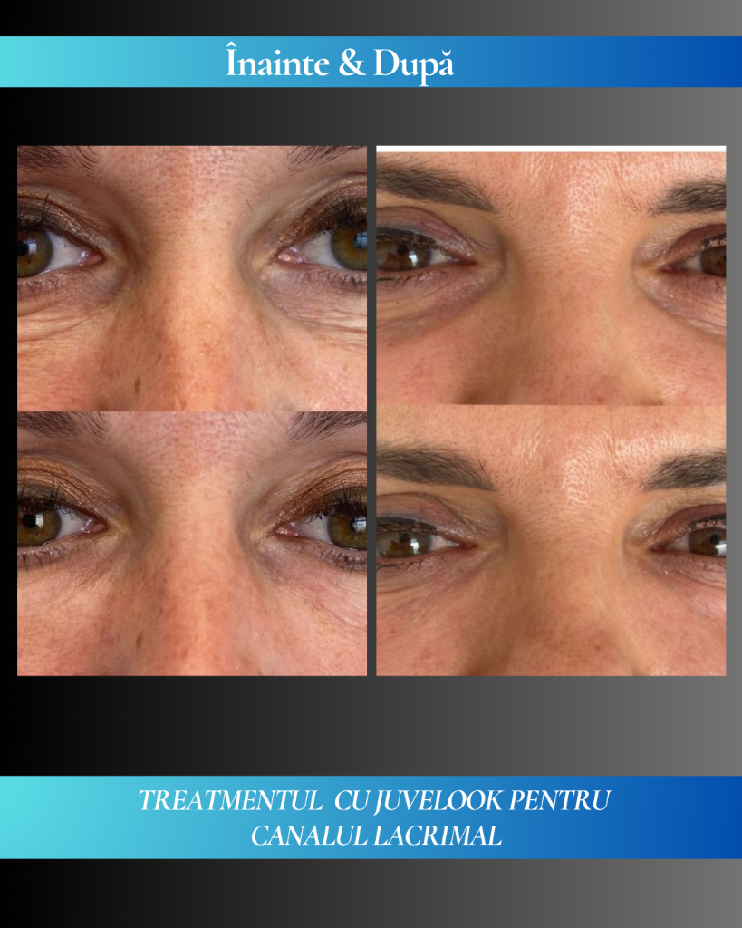 Rezultat clinic JuveLook 6